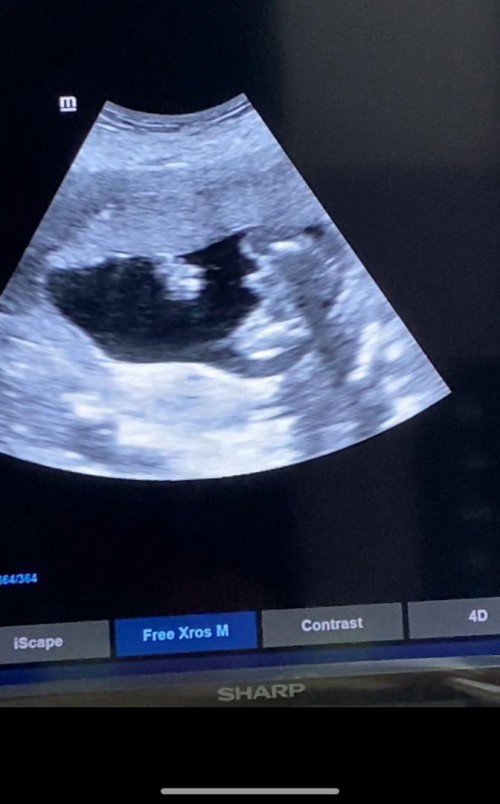 Baby gender