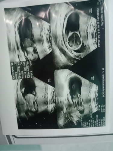 Usia 16weeks baru USg ada kelainan di organ perut janin🥺🥺🥺.. jadi kepikiran 😭😭😭😭😭😭😭😭😭
