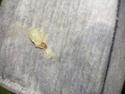MUCUS PLUG OR NORMAL DISCHARGE?