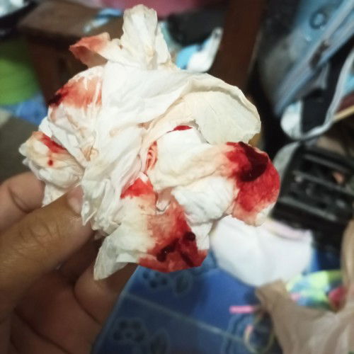 เอาถุงตั้งครรภ์ออกและขูดมดลูก