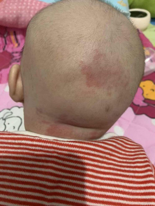 หัวลูกเป็นรอยแดง