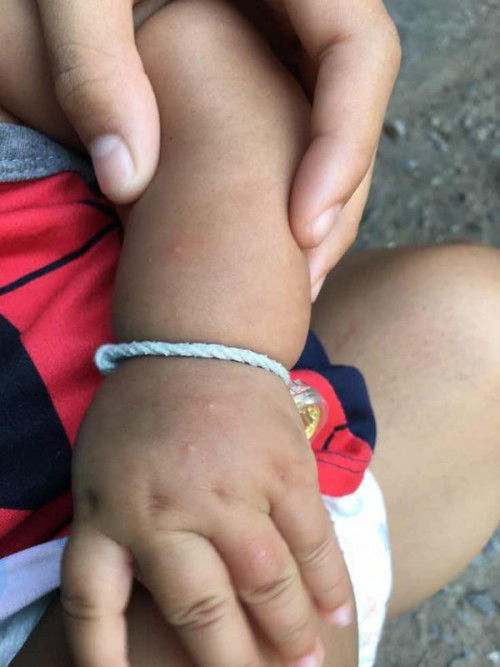 ตุ่มใสที่มือเกิดจากอะไรคะ