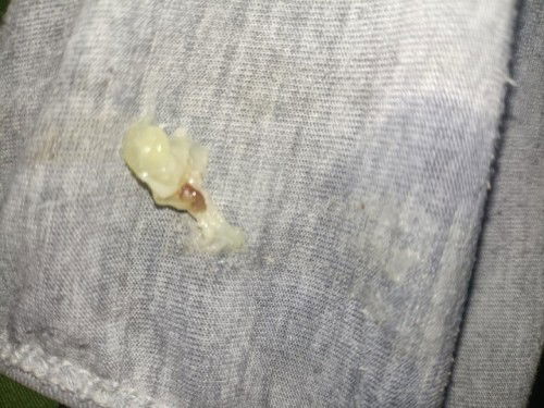 MUCUS PLUG OR NORMAL DISCHARGE?