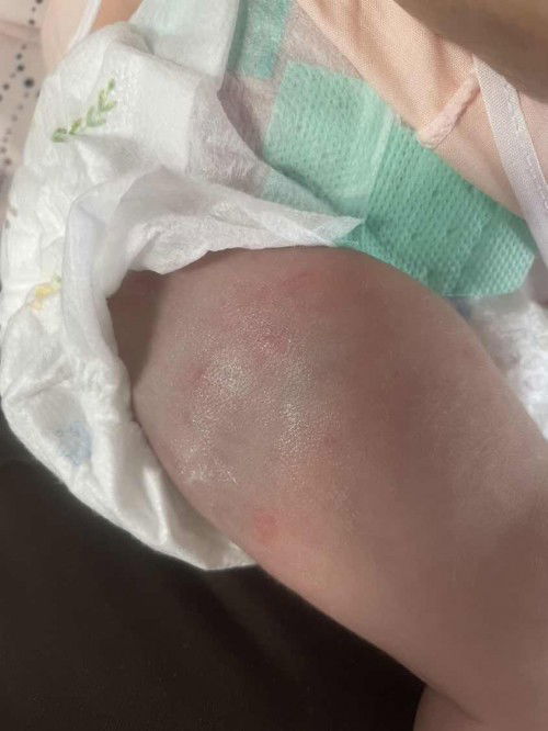 ผื่นแพ้ในเด็กทารก