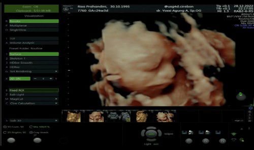 Rasanyaaaa pingin cepet2 usg