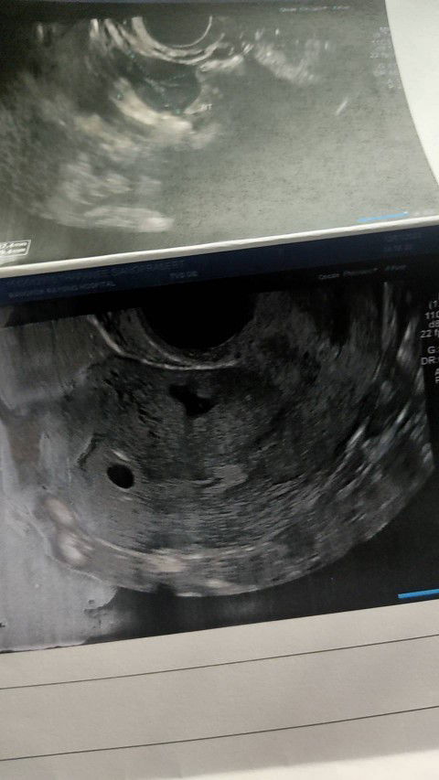 ขอสอบถามแม่ๆๆคะ ตอนนี้ท้องได้ 4 สัปดาห์ แล้ววันนี้ มีอาการเลือดออก นิดนึง เลยไปพบคุณหมอ อัลตร้าซาวด์