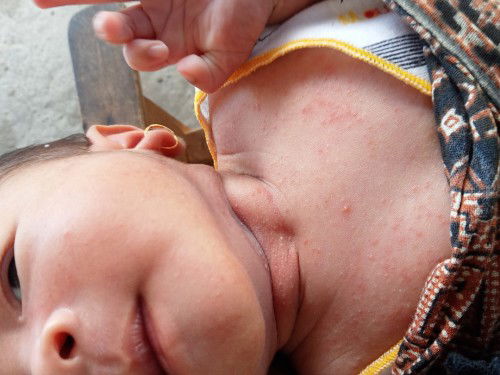 merah merah dileher dan badan