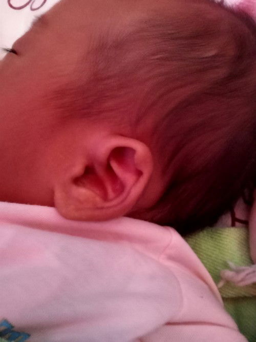 หูพับผิดปกติมั้ย