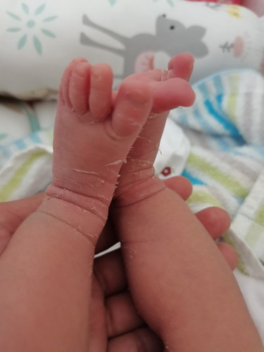 ผิวลอก👶👶