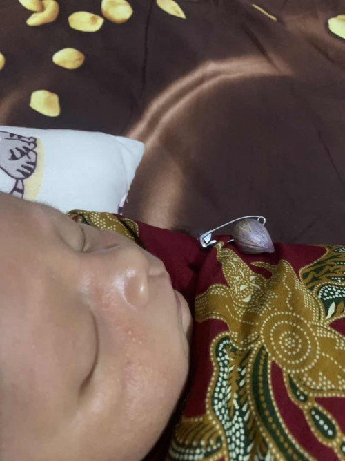 Pipi bayi seperti ada jerawat