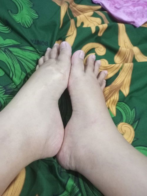 TM 3 kaki sangat bengkak