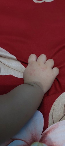 Bun adakah yg pengalaman bayi nya ada bintik2 merah begini, pakai apa supaya sembuh bun? ๐๐ฅบ