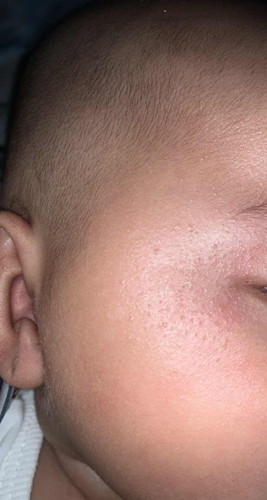 Eczema atau ruam biasa