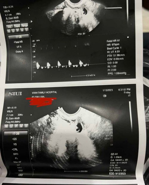 Ectopic pregnancy