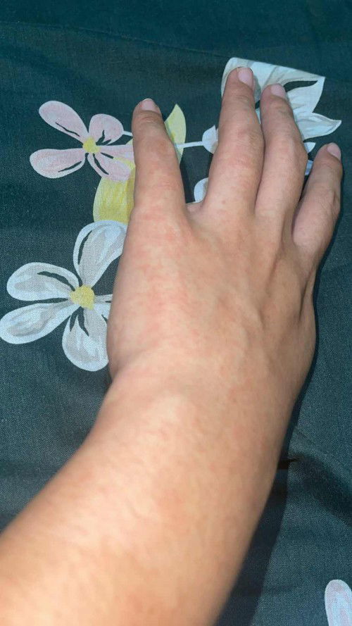 Kulit ruam ditangan tapi tidak gatal atau sakit sama sekali.