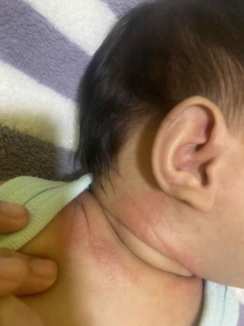 ฟลูกบ้านไหนเป็นแบบนี้บ้างคะ ใช้อะไรถึงหาย