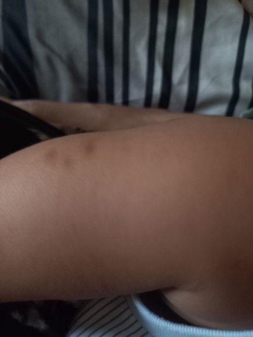 Bekas gatal menghitam