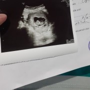 Alhamdulilah janinku bagus dn sehat setslh mngalami pendarahn dn kelaur gmpln darah smg sht trs
