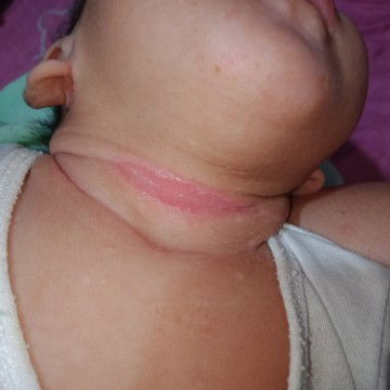 Ano po kaya ang pwde igamot dto ?
1month&23days si baby