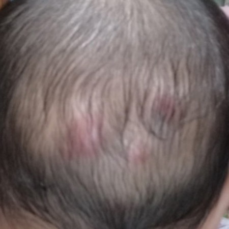 Insect Bite or Bukol?
