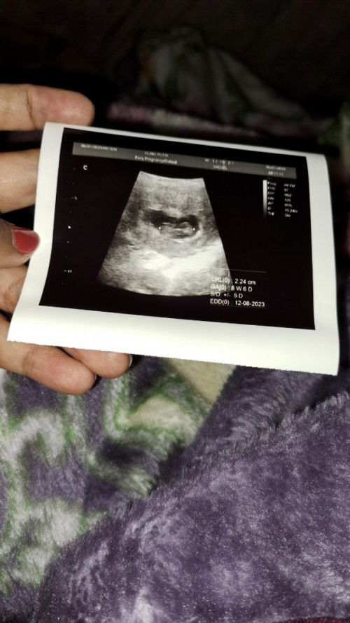 Senin saya usg,semua aman bun tapi 2 hari setelahnya flek dan disaranin buat dirawat