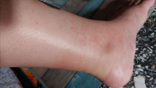 Kaki bengkak dan gatal