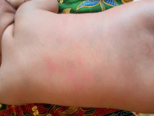 Bayi saya usia 6 bulan sudah beberapa minggu ruam di belakangnya hilang dan muncul. Mohon solusinya