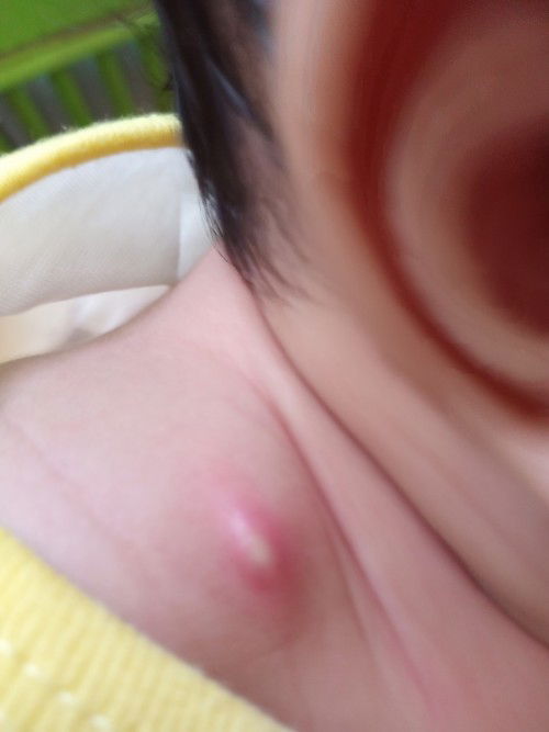 BUKOL SA LEEG NI BABY