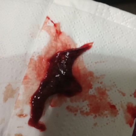 9 days delayed and negative pt