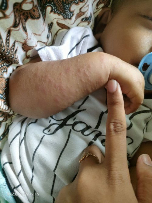 bintik merah ditangan dan kaki bayi