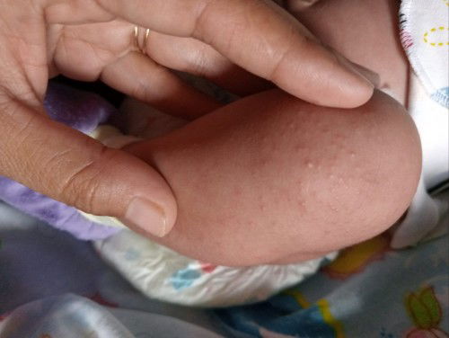 Cara menghilangkan bintik-bintik kecil