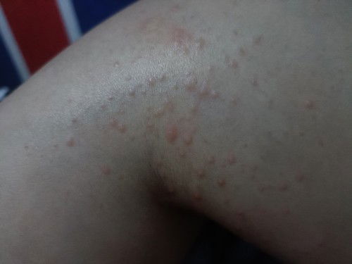 Ruam diperut dan kaki