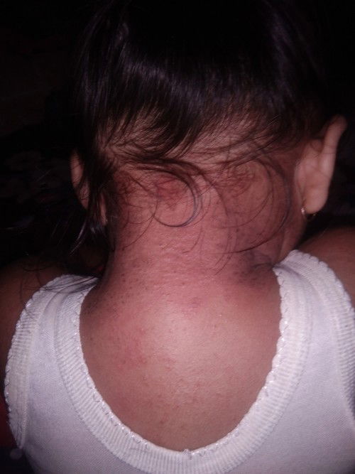 Biang keringet ga kunjung sembuh dan menyebar ke seluruh badan