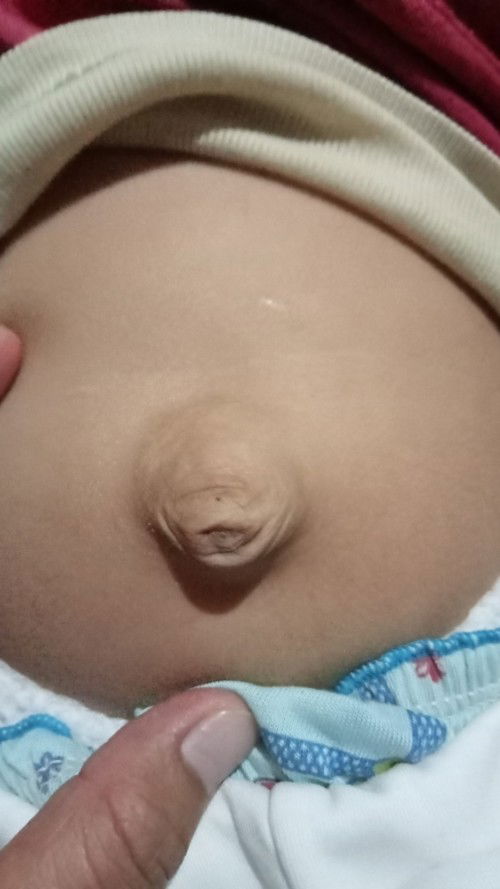 Bismillah. Umur 18bln pusar masih bodong.. solusinya donk bund gmna cara nya