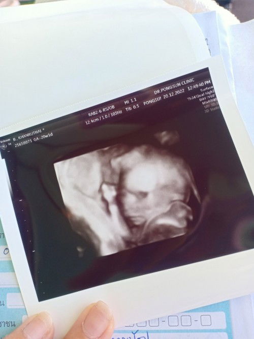 23week แล้ว แม่มีอาการยังไงกันบ้างคะ