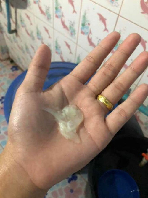 มูกขาวแบบนี้ผิดปกติมั้ย