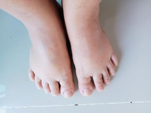 แม่ๆบวมแบบนี้บ้างมั๊ย