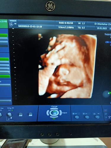 29+3week ลูกชายหนัก2.0โล ปกติต้อง1.1-1.2 คุณหมอบอกเกินเกณฑ์ไปมากท้องแรกก็ผ่าคลอด