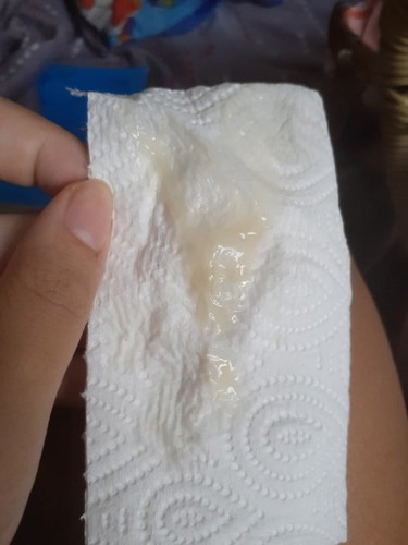 เมื่อวานเจ็บท้อง ปากมดลูกเปิดเซ็นเดียว วันนี้16:36มีมูกใสไหลออกมา