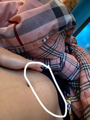 บ้านนี้ท้อง 17+2 มีอาการมดลูกลอยตัวแก้ยังไงดี แล้วจะมีโอกาสหายมั้ยคะ