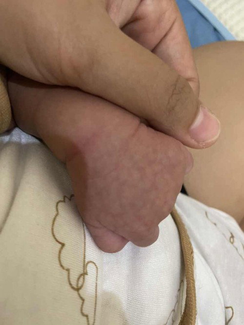 bintik di kaki dan tangan