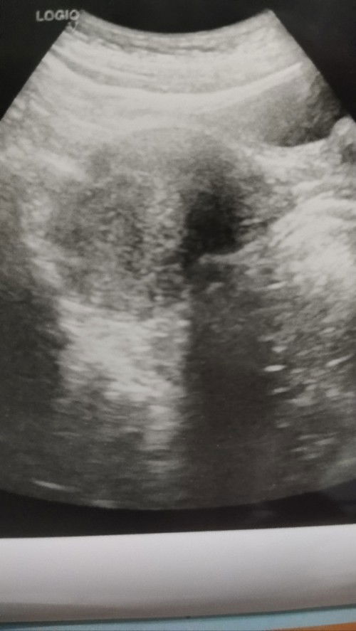 เมื่อวานมีมูกเลือดสีน้ำตาล วันนี้มีเลือดออกมานิดหน่อย