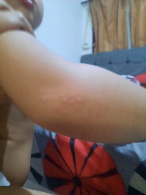 bintik merah pada bayi