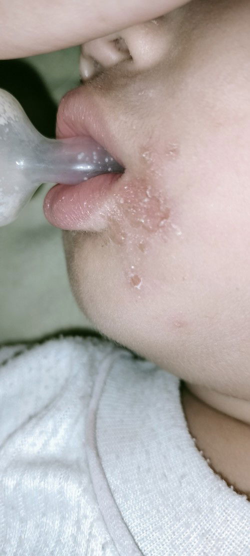 Gatal" di dekat bibir