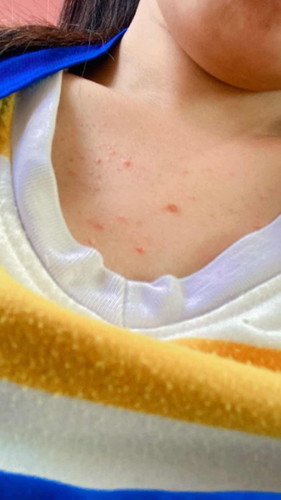 คุณแม่บ้านไหนแพ้ท้องแล้วขึ้นแบบนี้บ้าง