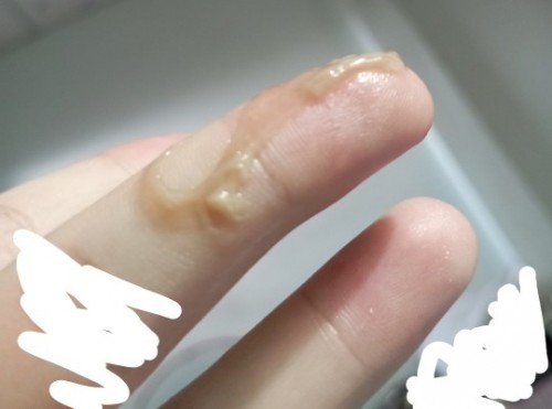 ขออภัยที่รูปไม่เหมาะสมด้วยค่ะ