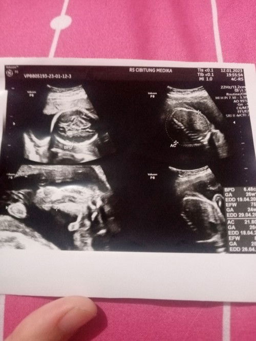 gambar usg  25 wek