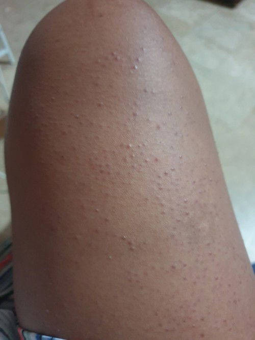 Butlig sa hita--Sino po may kaparehong symptoms? I'm in my 2months postpartum