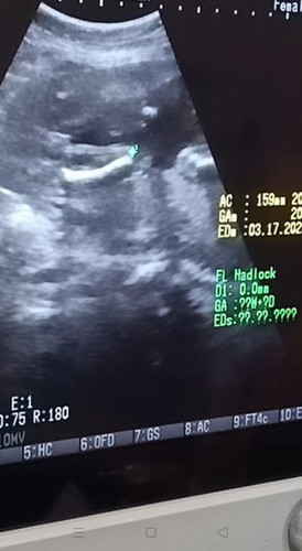 Boy or Girl