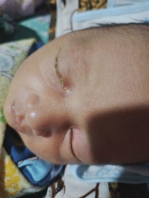 Adakah disini yg bayinya pernah belekan?
Dan bagaimana cara menangani nya?